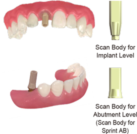 A line-up of Scan Body for IOS (Intra Oral Scanner), that can be used in the intraoral, enables optical impression.