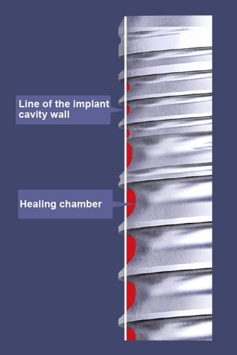 Healing chamber and insertion torque